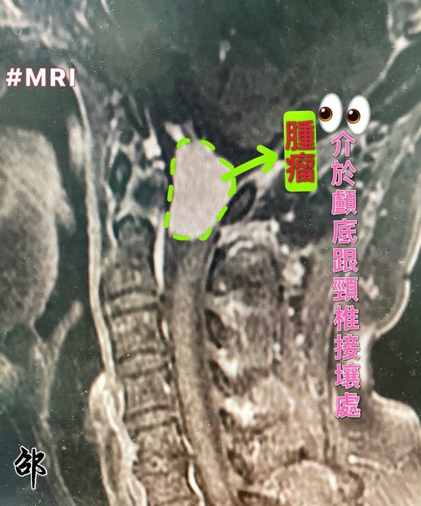 頸椎電腦斷層檢查及病人帶來的磁振照影（MRI），邵國寧研判陳姓婦人得了顱頸交接處腦膜瘤。（記者徐義雄攝）