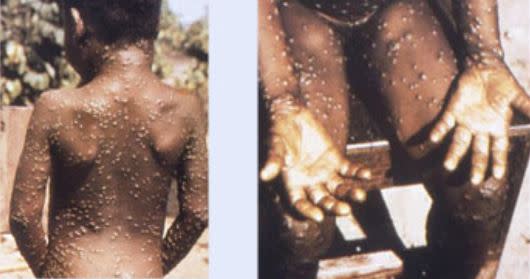 歐美多國都爆出「猴痘」（monkeypox）疫情。（圖／翻攝自美國CDC官網）