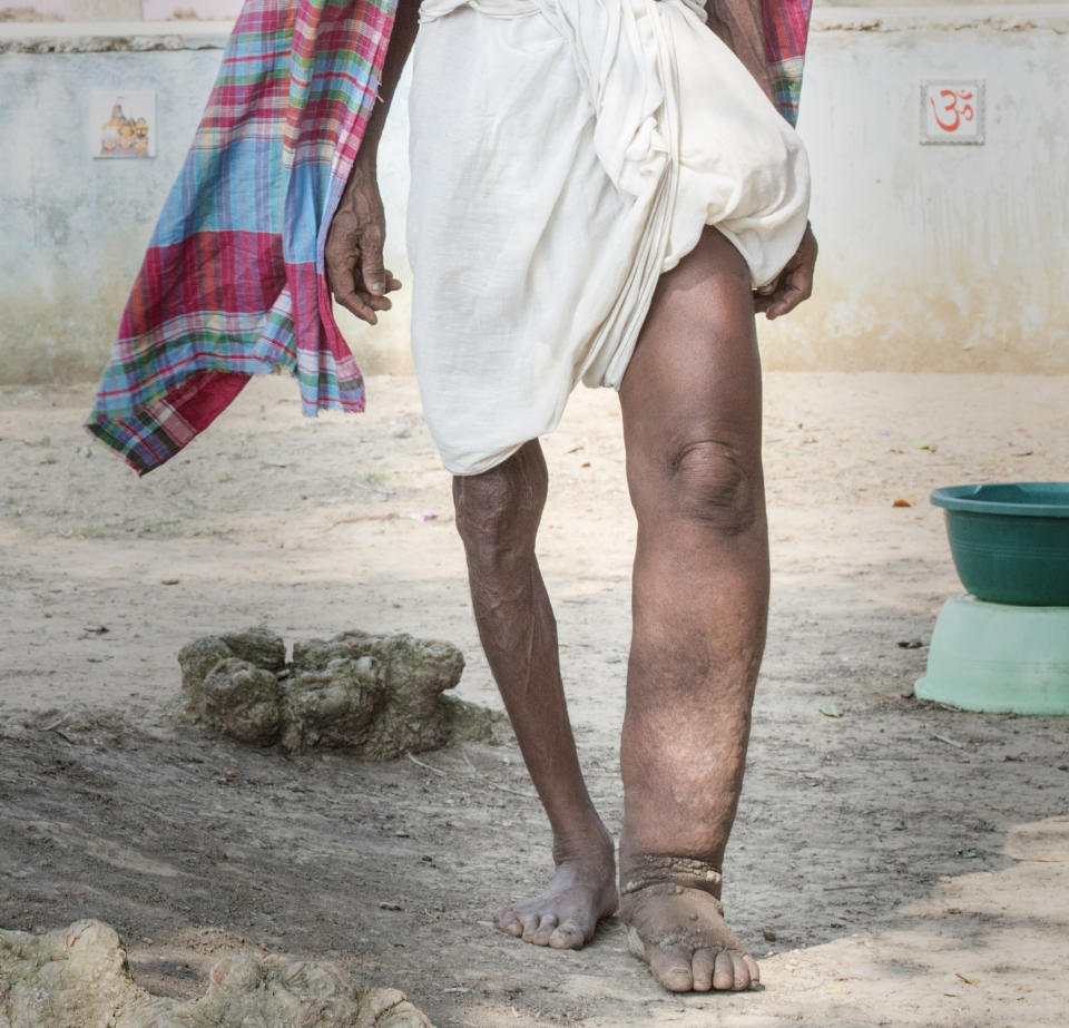 Lymphatic filariasis, more commonly known as elephantiasis, is a <a href="https://www.cdc.gov/parasites/lymphaticfilariasis/">leading cause of disability worldwide</a>, according to the U.S. Centers for Disease Control and Prevention. It affects <a href="https://www.cdc.gov/parasites/lymphaticfilariasis/gen_info/faqs.html">over 120 million people</a>&nbsp;globally and can cause severe swelling of body parts, including the legs and scrotum. While people are usually infected in childhood, the painful, disfiguring symptoms of the disease only&nbsp;<a href="http://www.who.int/mediacentre/factsheets/fs102/en/" target="_blank">show up later in life</a>.