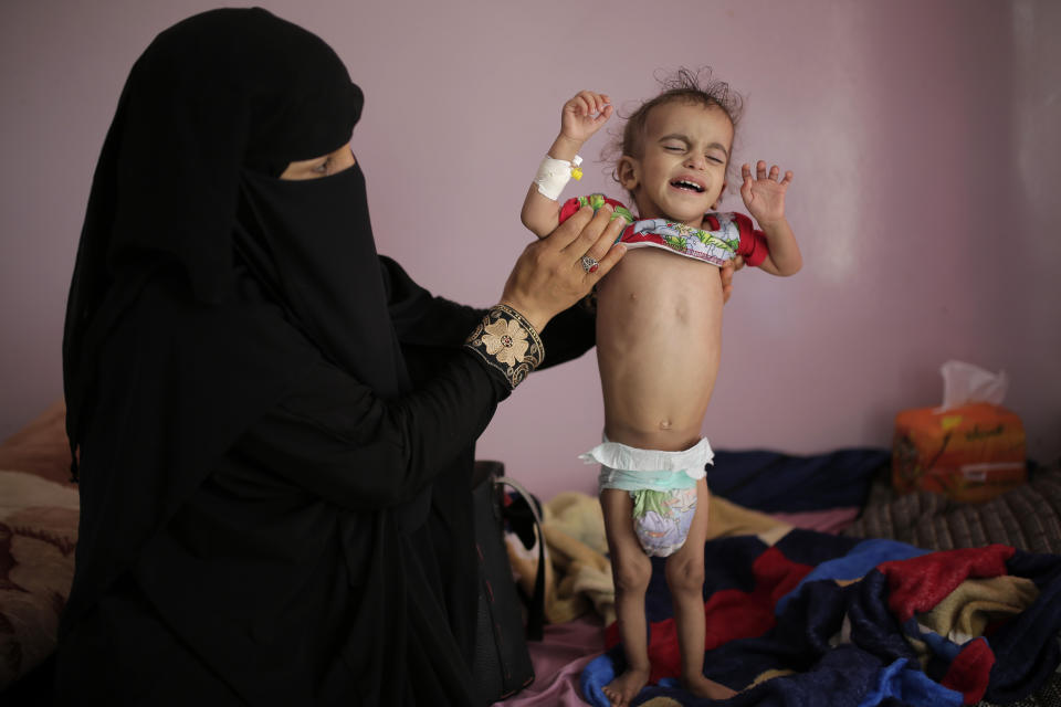 FILE - In this Nov. 23, 2019 file photo, a woman holds her malnourished boy at a feeding center at the Al-Sabeen Hospital in Sanaa, Yemen. After a visit to Yemen the World Food Program's executive director, David Beasley, warned that his underfunded organization may be forced seek hundreds of millions of dollars in private donations in a desperate bid to stave off widespread famine in the coming months. Beasley told The Associated Press in an interview Wednesday, March 10, 2021, that conditions in war-wrecked Yemen are “hell.” (AP Photo/Hani Mohammed, File)