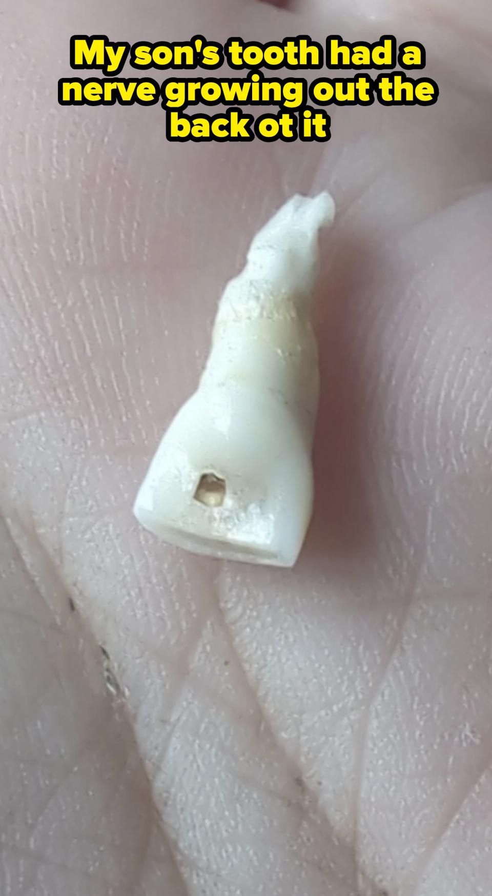 A close-up of an extracted human tooth resting on the palm of a hand, showing visible wear and a cavity on its surface