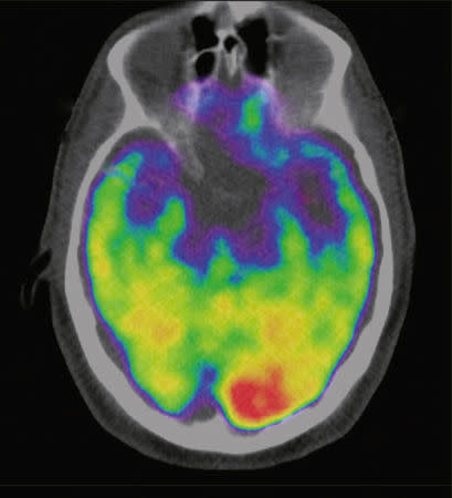 A scan of a brain used in a study carried out by Massachusetts General Hospital and Harvard Medical School which associates the brain region called the amygdala, an area linked to stress, to greater risk of heart disease and stroke is seen in an undated image released January 11, 2017 by The Lancet which published the reasearch. The Lancet Handout via REUTERS