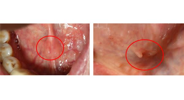 舌下阜（Sublingual caruncle）為舌繫帶兩旁突起的小肉球，亦為口腔內唾液腺管的開口處（左圖紅色圈圈處）；而繖襞（Fimbriated fold）則是位在舌腹，繫帶兩側各一的斜向黏膜皺襞，上面常常可見到一些小突起（右圖紅色圈圈處）。（圖片／吳昱學醫師提供）