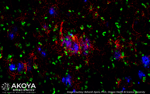 A brain tissue section (FFPE) from a patient who succumbed to Alzheimer’s was imaged with a 25-marker CODEX® panel. The image shows how the patient’s brain was littered with protein plaques (amyloid, blue) and how the glial cells (GFAP, red) circle around the plaques, trying to contain the damage. The CODEX® System enables researchers to visualize dozens of biomarkers in a single tissue section and study disease biology with greater depth and resolution.