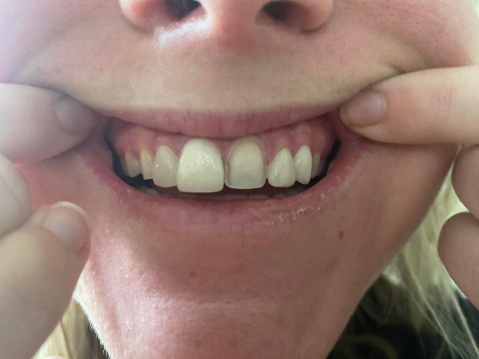 A picture of Grace Fewell stretching her mouth to show the top row of her teeth, where one veneer has fallen off.