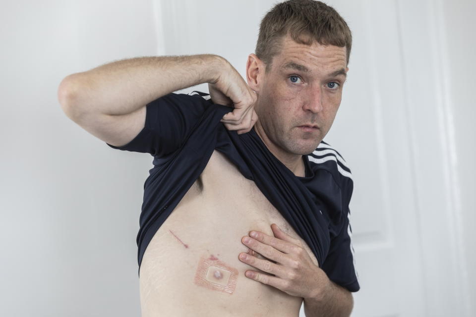 Scars left from surgery. Roofer Alex Gittins, 31, is taking legal action against  Easi-Vape over allegations a dodgy product left him with a collapsed lung, pictured in North Yorks, Jul 7 2023. See SWNS story SWTPvape. A roofer is taking legal action against a vape shop over allegations a dodgy product left him with a collapsed lung. Alex Gittins, 31, wants Easi-Vape to be shut down and has hired a lawyer to pursue a claim. He says a Crystal Bull Ice vape bought from the shop in Bishop Auckland, Co. Durham caused him serious damage. Alex claims his injuries have forced him to sign off from work, meaning he is losing out financially.