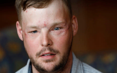 US man Andy Sandness recieved a face transplant and is on a daily regimen of anti-rejection medication - Credit: AP Photo/Charlie Neibergall