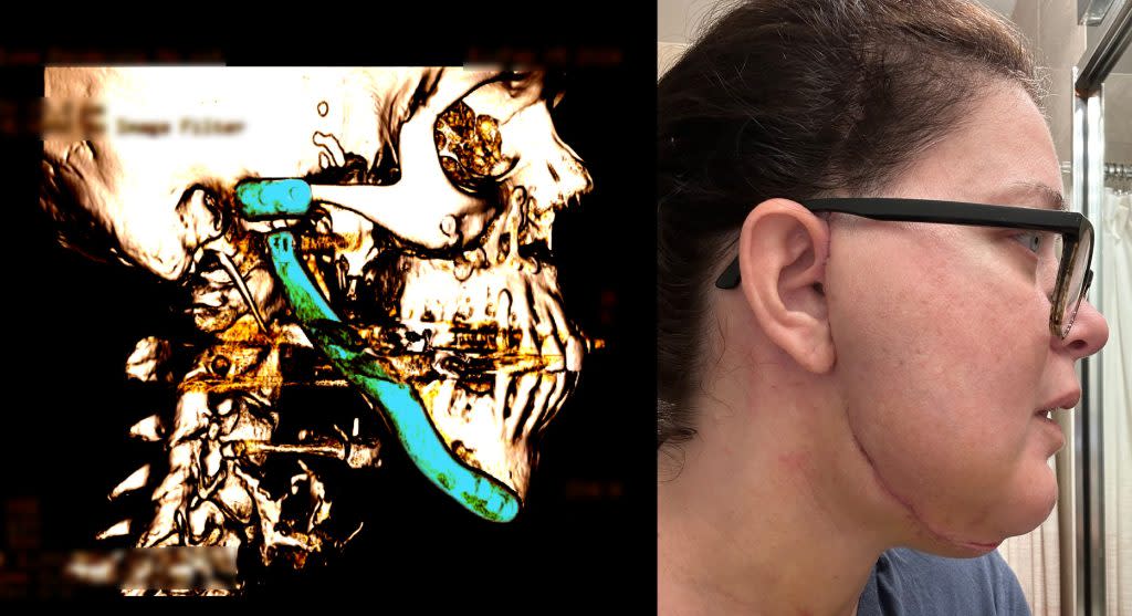 Left: Jenny Feldman’s total jaw replacement implant can be seen in this 2024 medical scan. (The implant has been highlighted blue with photo-editing software. Text on the scan has been blurred to protect privacy.) Right: A long scar stretches along the right side of Feldman’s face and jaw in 2023 after her second total jaw replacement surgery. (Left: Medical scan provided by Jenny Feldman, image made by Brett Kelman and Eric Harkleroad/KFF Health News; Right: Jenny Feldman)