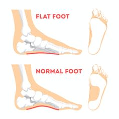 A flat foot compared to a normal foot