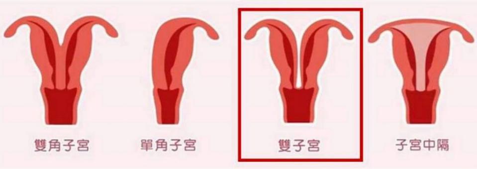 造成子宮與陰道的先天結構異常，常見的型態還有雙角子宮、單角子宮、子宮中隔等。（記者陳金龍翻攝）