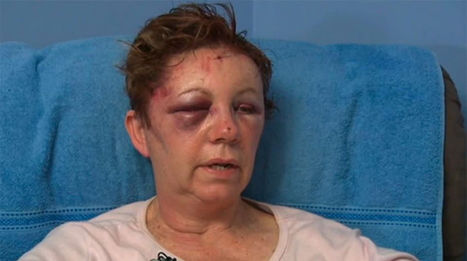 Mary was kicked in the face and said it's lucky her jaw wasn't broken. Source: 7 News