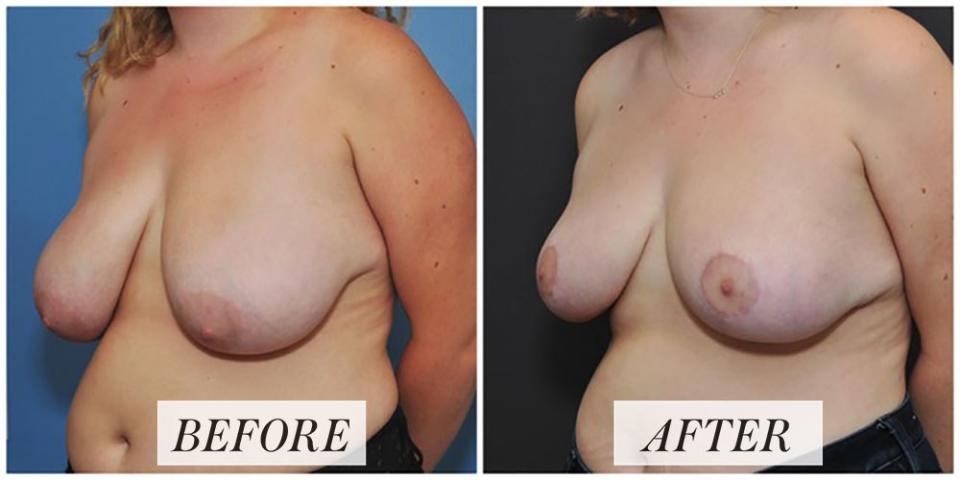 <h1 class="title">Life in Plastic: Breast Reduction Surgery Before-and-After Images.jpg</h1><cite class="credit">Courtesy of David Sieber</cite>