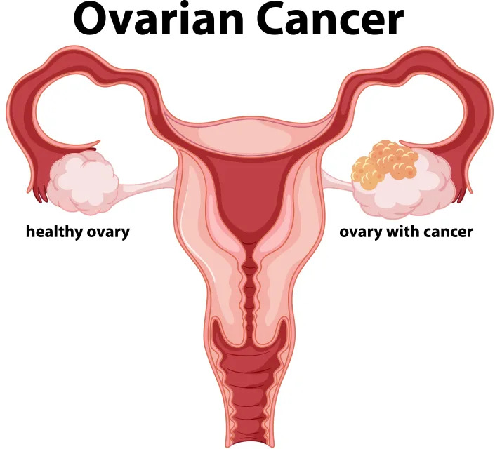 Ovarian cancer is a group of diseases that originates in the ovaries. (Photo via Getty images)