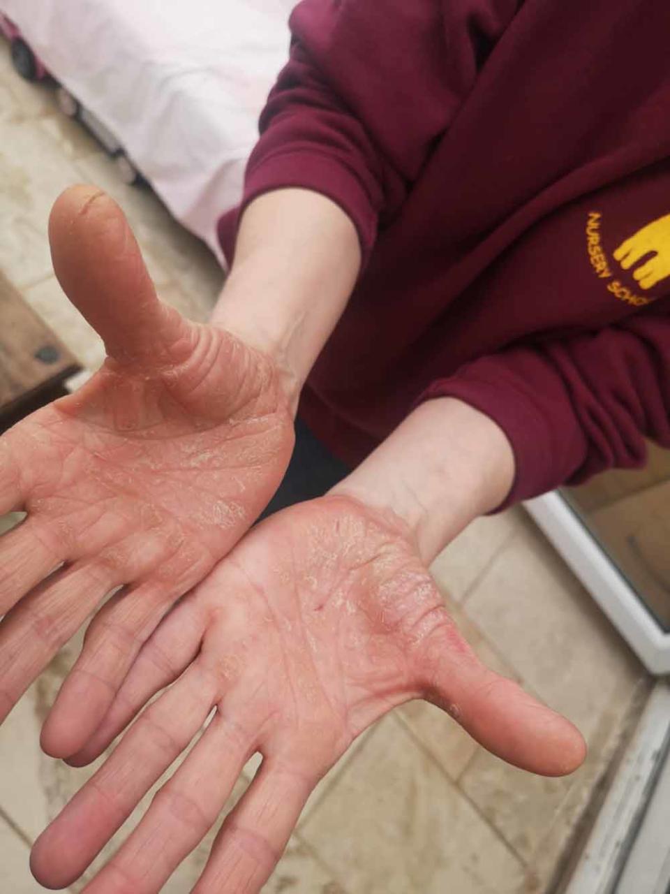 The mum was prescribed various treatments for her hands but to no avail. (Collect/PA Real Life)