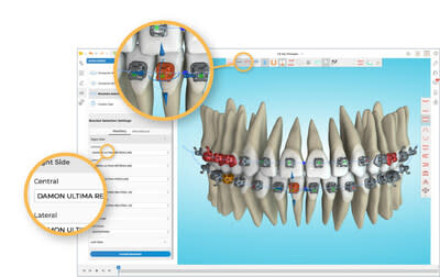 Digital treatment planning and digital bracket placement interface with Spark Approver Software provides one easy-to-use software platform for your Spark Clear Aligner cases and your Digital Bonding cases.