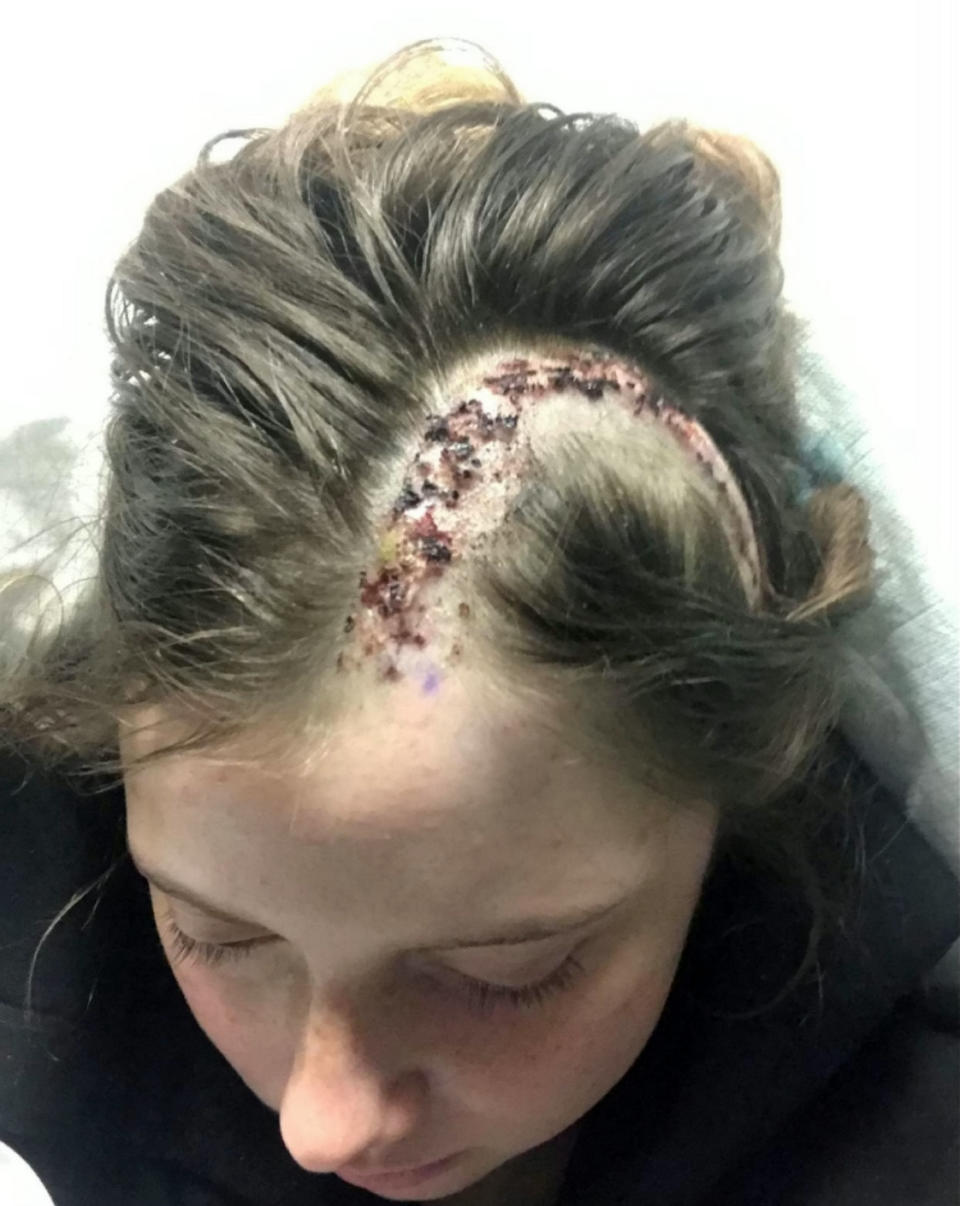 Laura Skerritt's post operation scar. See SWNS story SWBRtumour. A 22-year-old from Templecombe whose brain tumour was misdiagnosed as a mental illness is opening up about her terrifying ordeal. When Laura Skerritt began suffering from migraines, sickness and psychosis, she was prescribed anti-depressants and told that her symptoms were caused by anxiety, depression or even that she was bi-polar. The medication had no effect on Lauras condition and over time she deteriorated further. By November 2018, she was struggling to walk and having seizures. A scan at Yeovil District Hospital revealed the news that Laura and her worried parents, Mark and Kate, feared the most. Laura was living with a tennis ball-sized brain tumour and she needed emergency surgery to prevent her having a potentially fatal stroke or seizure.