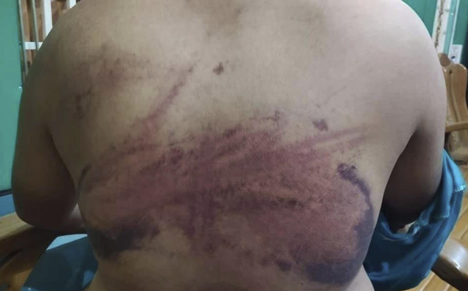 This photo obtained by The Associated Press shows injuries a man in his 20s says he received while being tortured by Myanmar's military during an interrogation session in March 2021. He says he was one of six youths who were arrested while sitting at a restaurant one evening. All of them were allegedly beaten during their arrest and questioning. They were released the next day. (AP Photo)