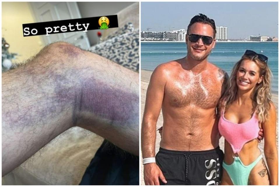 Gary Lucy has given a look at the nasty bruising he sustained in a car crash on Boxing Day  (Instagram)