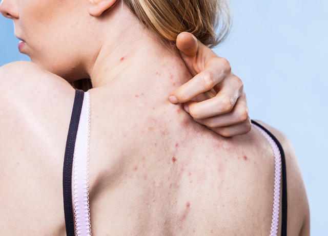 We Ask a Derm: How Do I Clear Up Bacne and Back Acne Scars?