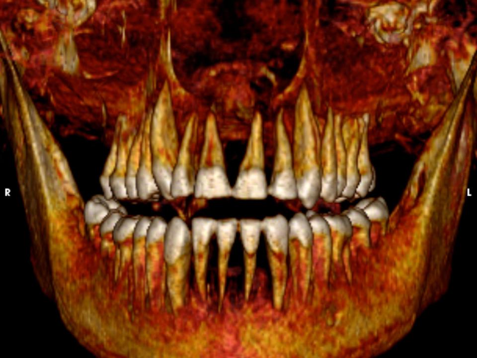 A 3D reconstitutions provides a view of Amenhotep's teeth.