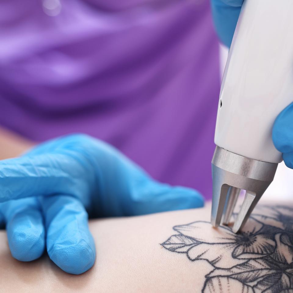 <h1 class="title">skin-care glossary: laser tattoo removal</h1><cite class="credit">Getty Images</cite>