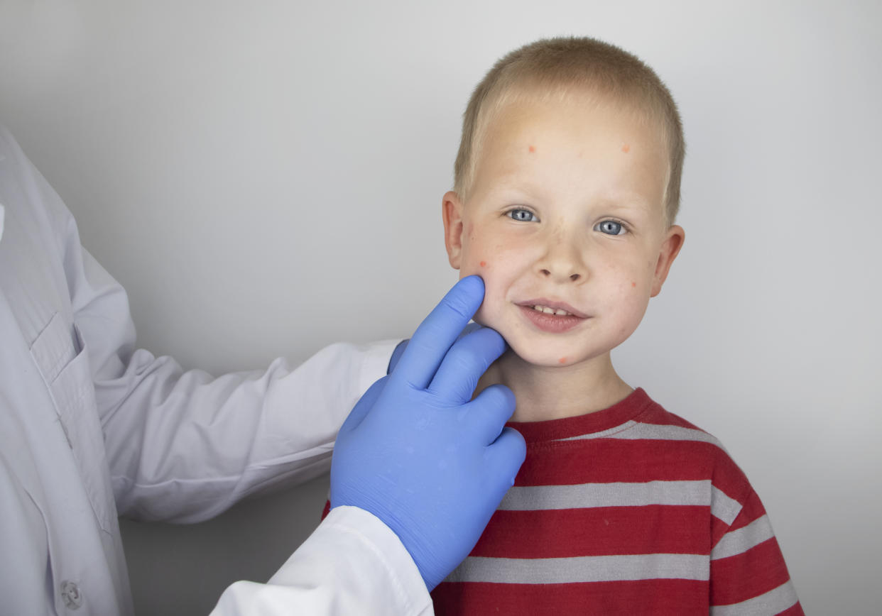 A young white boy in a red and gray striped tee, with red marks on his face, gets examined by a doctor wearing blue gloves.