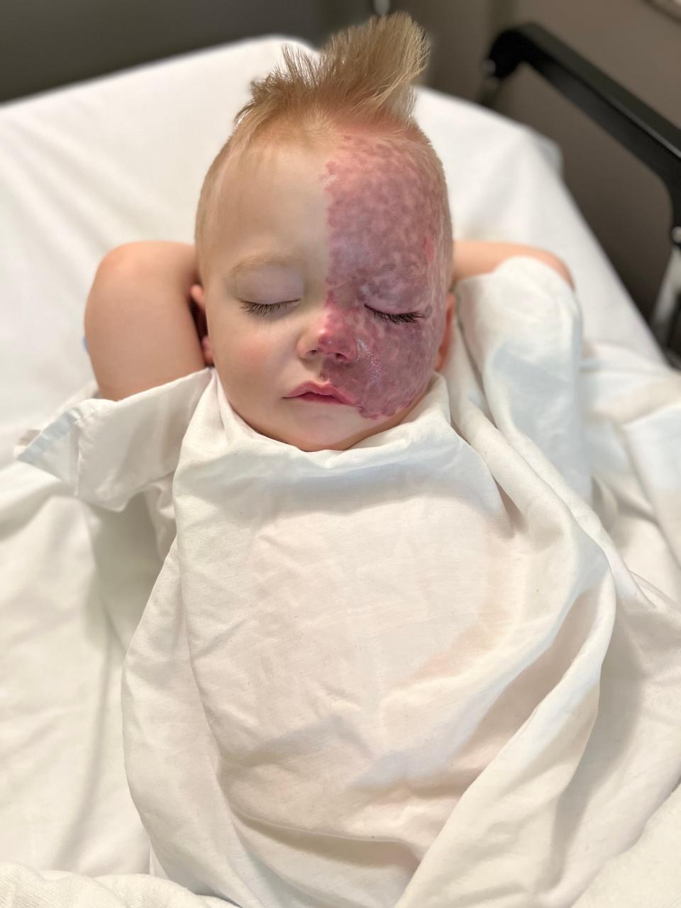 Tucker Lewis rests during one of his infant hospital stays in this undated photo. Now age 4, he has undergone 20 laser treatments on his port-wine stain birthmark. The laser treatment helps preserve the skin.