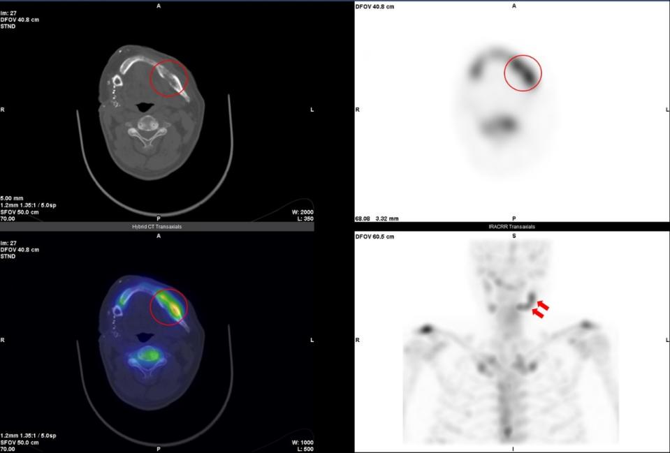 以單光子電腦斷層掃描精準定位出病灶的位置，並且在同步電腦斷層影像的配合下，更精確指出該處為下顎骨的蝕骨性破壞併周邊骨質增生（以紅圈標示處）