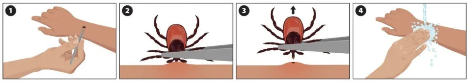 Four images displaying how to remove a tick with tweezers