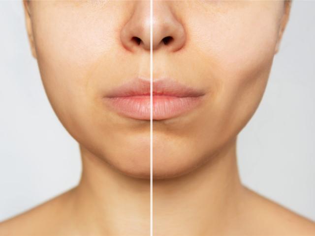 What is buccal fat removal? Experts explain the real effects