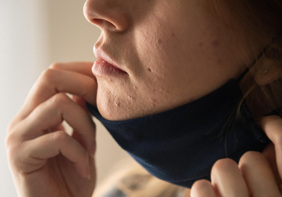 For some the wearing of face coverings has caused something known as 'maskne'. (Getty Images)