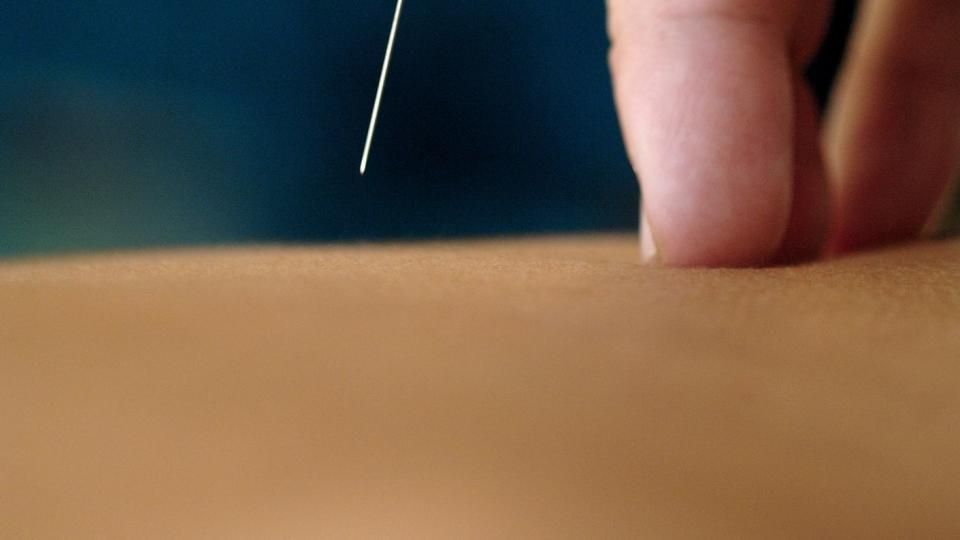 acupuncture treatment