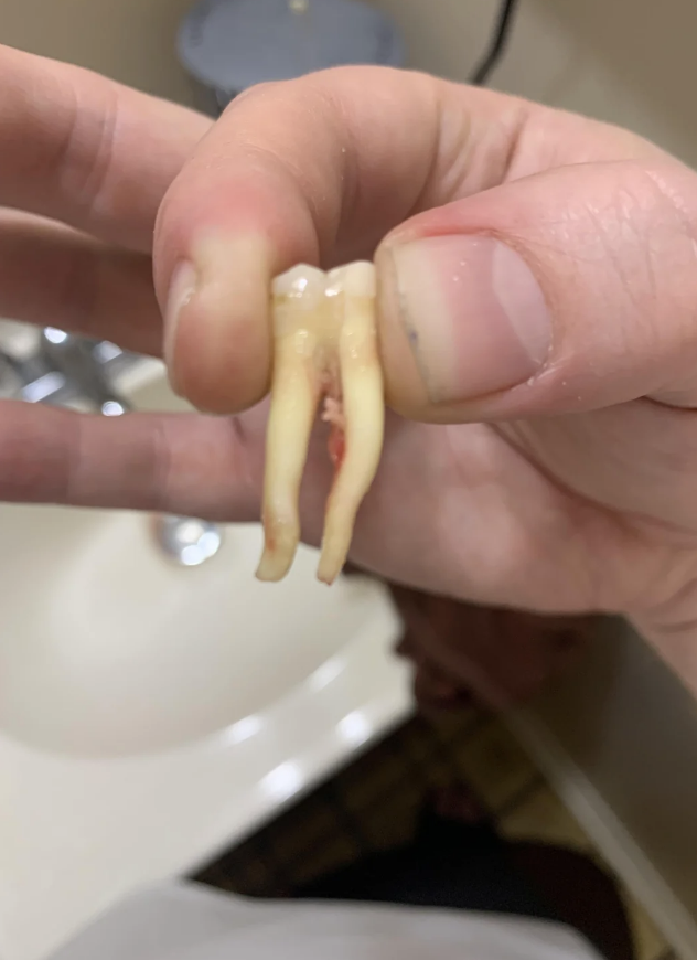 A hand holding an extracted molar with long roots over a bathroom sink