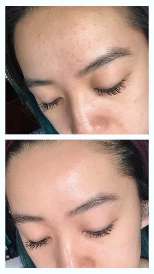 <cite class="credit"><a href="https://www.reddit.com/r/AsianBeauty/comments/day2a8/sudden_encounter_with_fungal_acne_but_soothed_in/" rel="nofollow noopener" target="_blank" data-ylk="slk:Aphylaxis;elm:context_link;itc:0;sec:content-canvas" class="link ">Aphylaxis</a>/Reddit</cite>