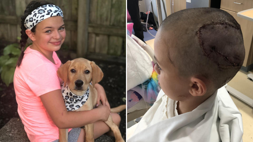 Savannah Coleman two years after the dog attack (left) and her head covered in stitches after the dog attack (right).
