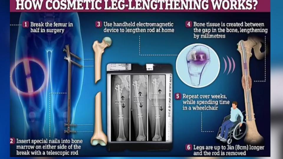 「斷骨增高手術」費用昂貴且術後恢復過程艱辛。（圖／翻攝自《每日郵報》）