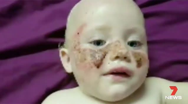 The blister reaction on little Chloe's face. Source: 7 News