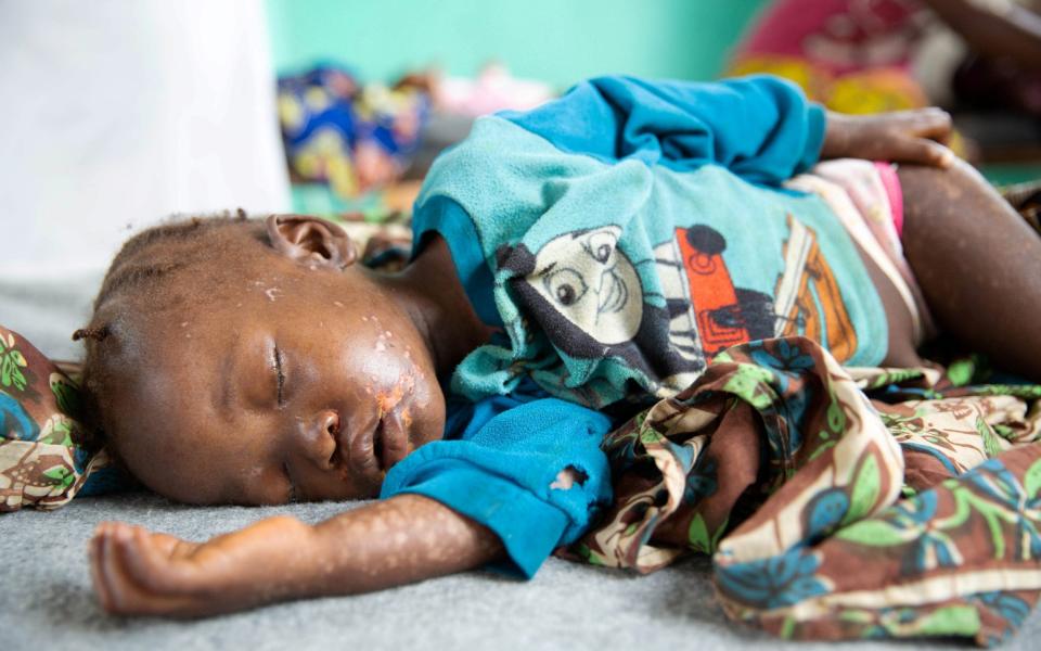 Three-year-old Dobo Mbanza, who developed complications that may leave her blind after contracting measles, lies on a bed in the measles isolation ward in Boso-Manzi hospital in Mongala province in northern Democratic Republic of Congo - Hereward Holland/REUTERS