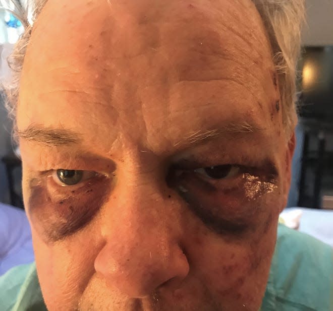 This image, provided by attorneys for Dr. Stephen Brennan, shows injuries to Brennan's left eye and head that they say Brennan sustained after he was pulled over by the York Police Department in 2019 and "subjected to a brutal assault by a York police officer and his canine."