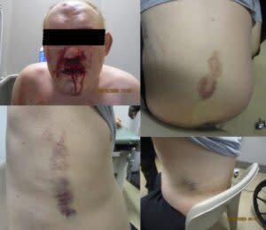  A patient advocate took photos of J.P., a patient at William R. Sharpe Hospital, that showed his bloody face and bruising in the outline of a shoe on his bare side. (Courtesy photos)