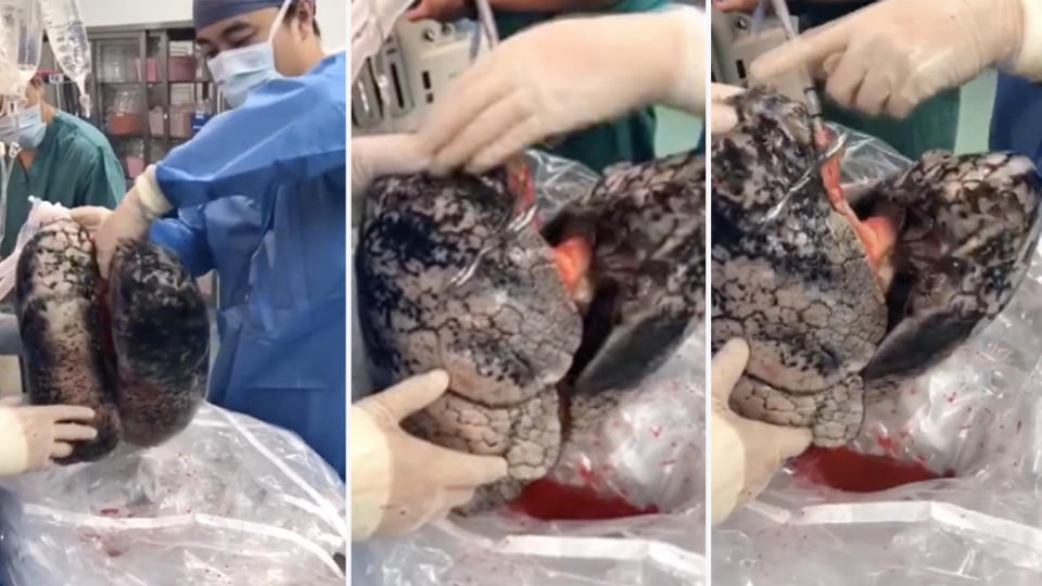  viral clip of dead chain smoker's black lungs being examined. 