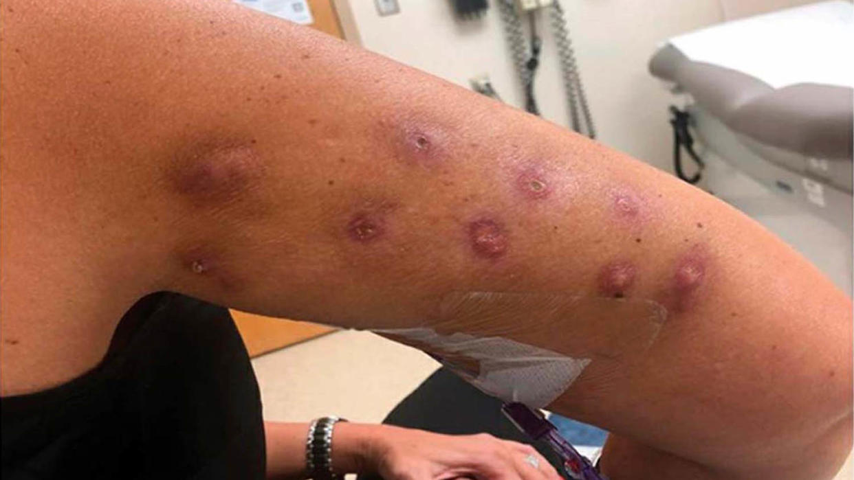 Appearance of the knots after two months of antibiotic treatment. (Kaur, H, C Reyes-Barron, WH Sipprell, A Cameron, T Louie, PR Tsai, and G Scott / via FDA)