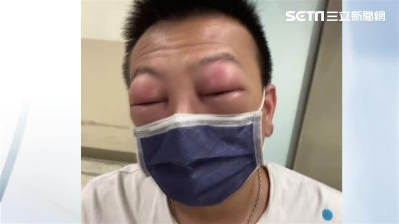 男子吃中藥竟引發過敏，眼睛超腫！