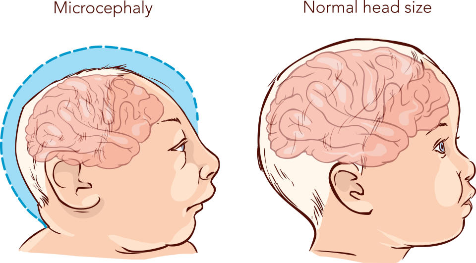 Illustration of a newborn baby with Microcephaly disease caused by Zika virus