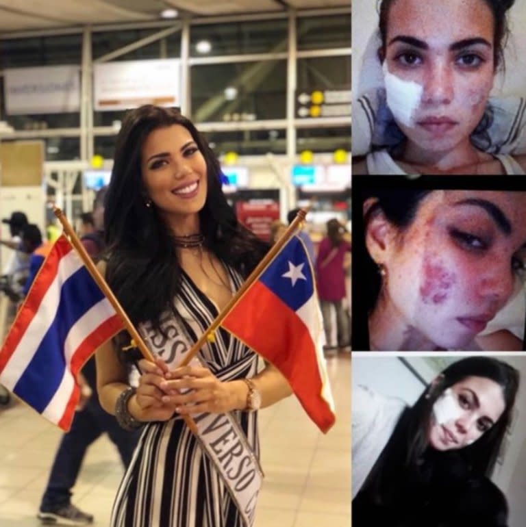 Andrea Díaz, Miss Chile, fue quemada en el rostro con una sustancia. <a href="https://www.instagram.com/andruwdiaz/?hl=en" rel="nofollow noopener" target="_blank" data-ylk="slk:Foto: Andrea Díaz, Miss Chile/Instagram;elm:context_link;itc:0;sec:content-canvas" class="link ">Foto: Andrea Díaz, Miss Chile/Instagram</a>