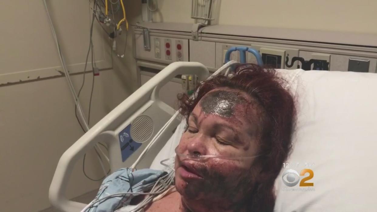 Police say Lizzie Dunn recanted her story after telling police a stranger sprayed her in the face with a harmful substance. (Photo: CBS2).