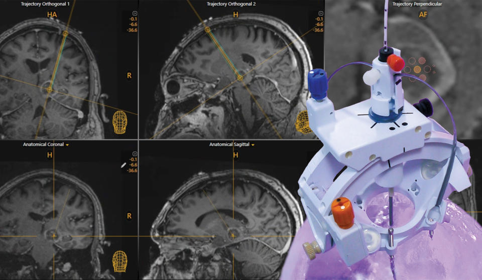 The SmartFrame Array system offers stability and flexibility for neuro navigation, with a highly rigid frame and an 'array' of six offset channels to simplify multi-trajectory procedures and entry point adjustments. The Array software provides an intuitive user interface with options for performing entire procedures in the MRI or starting in the operating room.