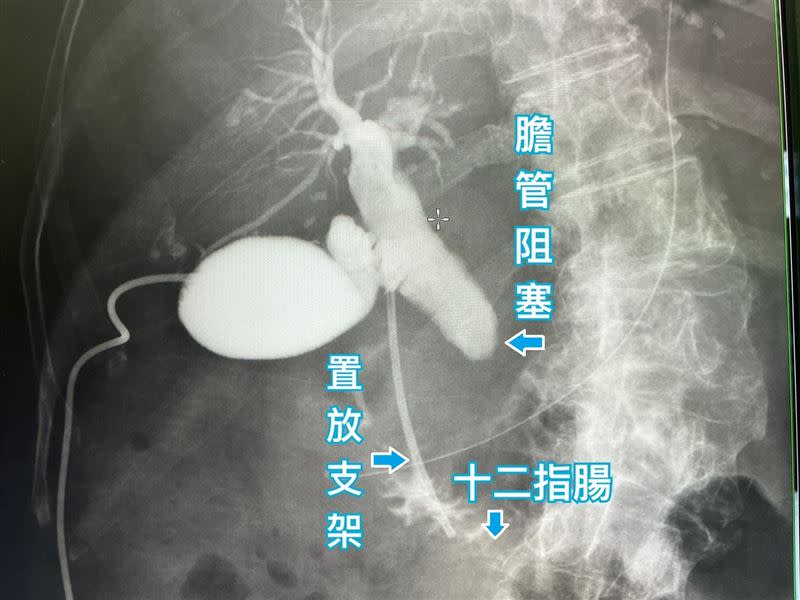 「膽管十二指腸造口術」為治療胰臟癌引起的黃疸新選擇（圖／烏日林新醫院提供）