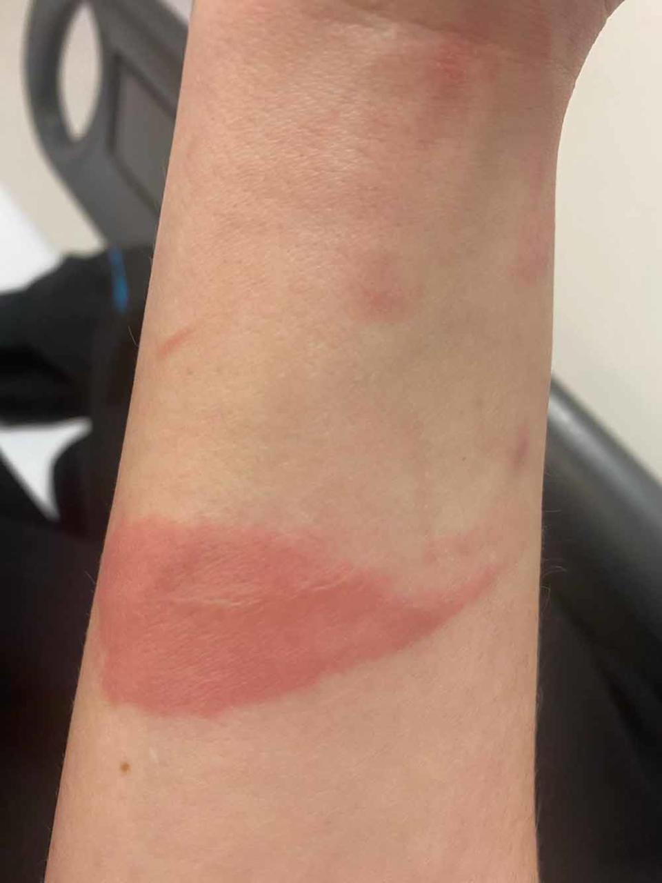 Paige was left with burn scars from the accident. PA REAL LIFE COLLECT