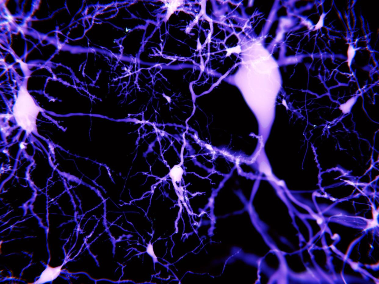 Beta-amyloid is a substance thought to be involved in destroying brain connections in Alzheimer's disease: Getty